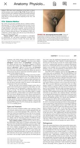 x
Anatomy Physiolo...
E
children, AGS often causes enlargement of the penis or clitoris
and the premature onset of puberty (fig. 17.28). Prenatal AGS can
result in newborn girls exhibiting masculinized genitalia and being
misidentified as boys. In women, A