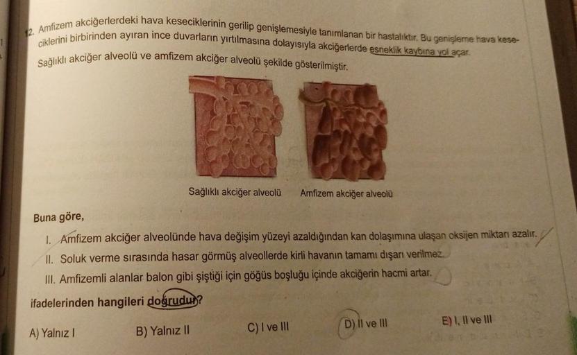 1
12. Amfizem akciğerlerdeki hava keseciklerinin gerilip genişlemesiyle tanımlanan bir hastalıktır. Bu genişleme hava kese-
ciklerini birbirinden ayıran ince duvarların yırtılmasına dolayısıyla akciğerlerde esneklik kaybına yol açar.
Sağlıklı akciğer alveo