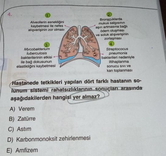 4.
Alveollerin esnekliğini
kaybetmesi ile nefes
alışverişinin zor olması
Mycobakterium
tuberculosis
bakterilerinin etkisi
ile bağ dokusunun
elastikliğini kaybetmesi
ang
Bronşçuklarda
mukus salgısının
aşırı artmasına bağlı
ödem oluşması
ve soluk alışverişin