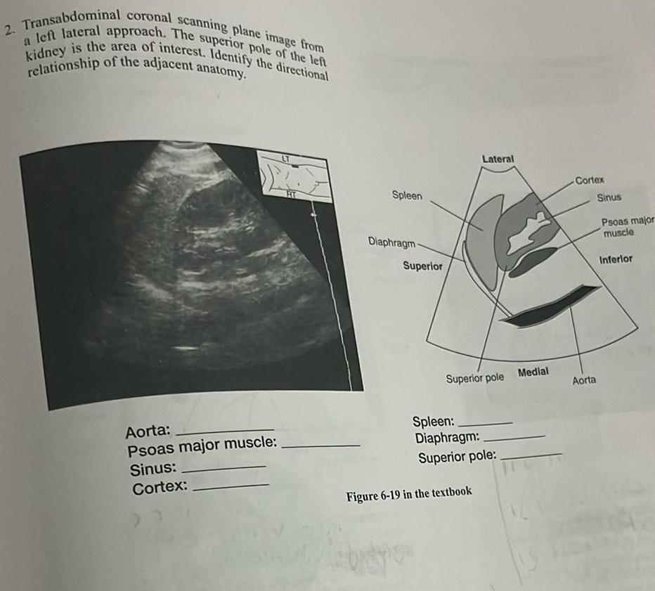 2 Transabdominal coronal scanning plane image from a left lateral approach The superior pole of the left kidney is the area of interest Identify the directional relationship of the adjacent anatomy Aorta Psoas major muscle Sinus Cortex Spleen Diaphragm Superior Lateral Superior pole Spleen Diaphragm Superior pole Figure 6 19 in the textbook Medial Cortex Aorta Sinus Psoas major muscle Inferior